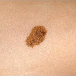 Example of moleRemoval